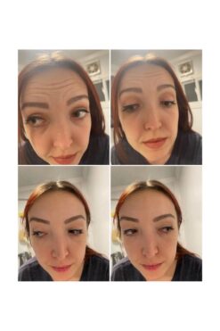 İnka Roller 50 Cm Yüz Bandı Yüz Gerginliği Lifting Kolajen Bant Kırışıklık Germe Estetik Alın Ve Nazolabial