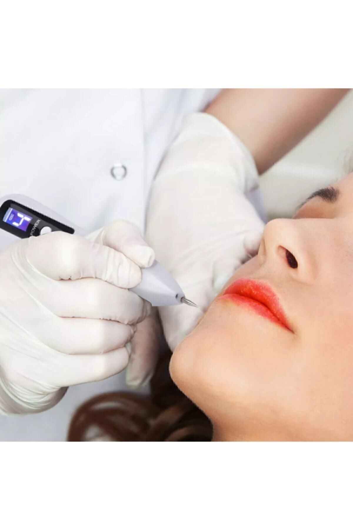 Plexr Plasma Pen - Akne, Yara Izi, Ben, Dövme, Siğil,çatlak Silme Temizleme Kalemi (9 KADEME) - Görsel 2