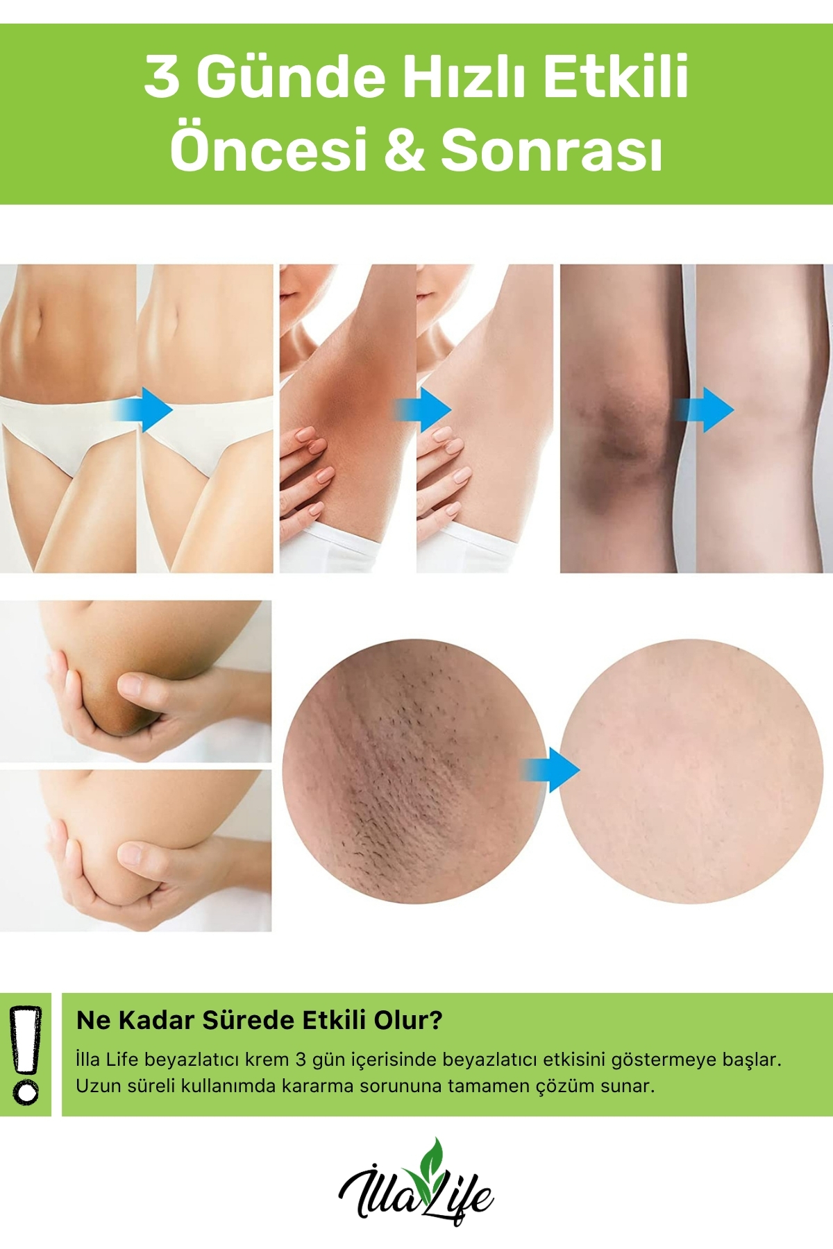 İlla Life Hızlı Etkili Kararma Karşıtı Cilt Beyazlatıcı Koltuk Altı Özel Bölge Bikini Bölgesi Beyazlatma Kremi - Görsel 3