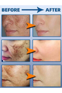 Genel Markalar Pyary Güzellik Kremi Çil - - Akne -Siyah Nokta Cyasma Karşıtı Beyazlatıcı Krem Seti