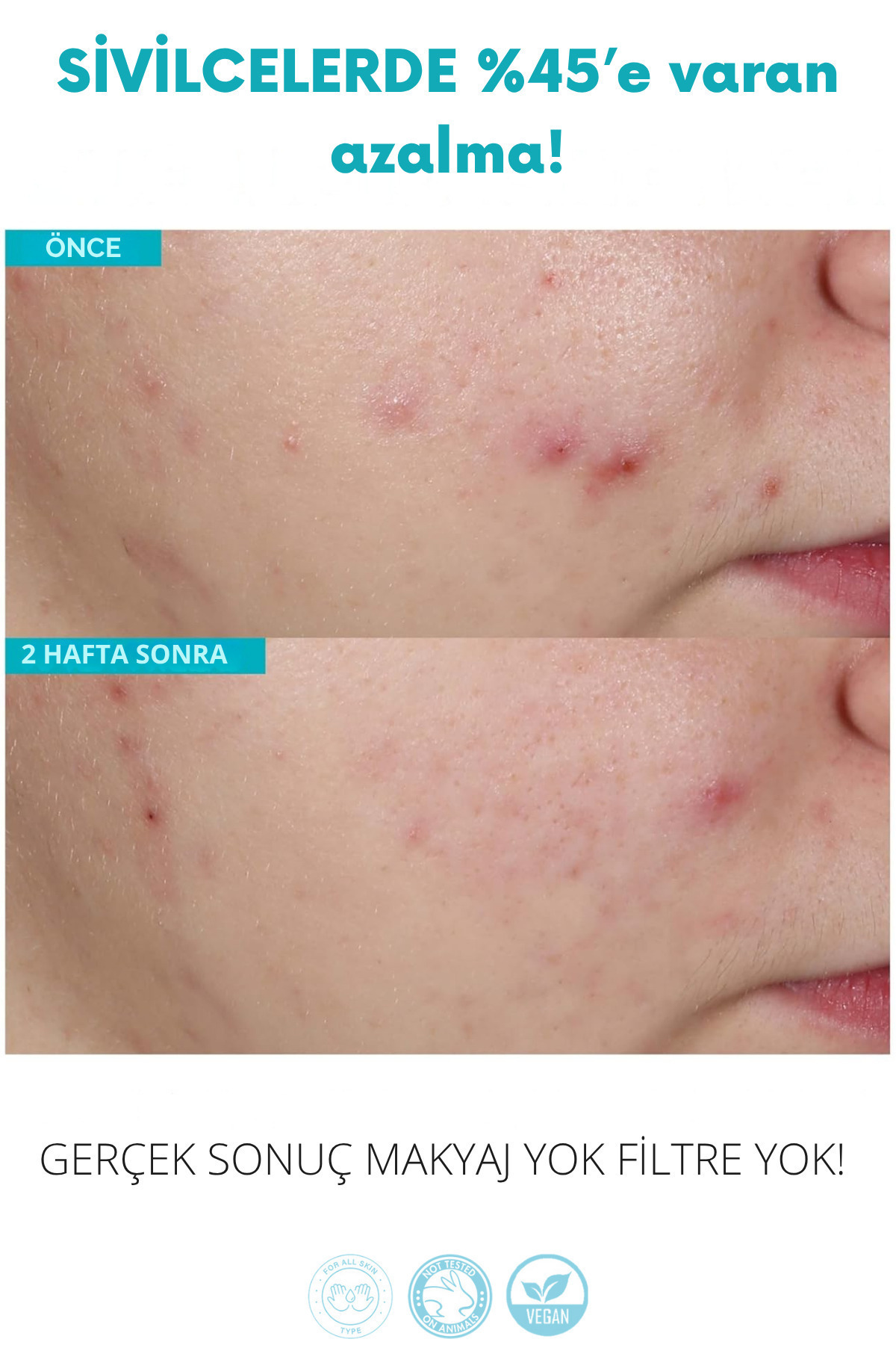 Dermotik Siyah Nokta Ve Sivilce Karşıtı Niacinamide & Salisilik Asit Gözenek Sıkılaştırıcı Akne Serumu 30 Ml - Görsel 2