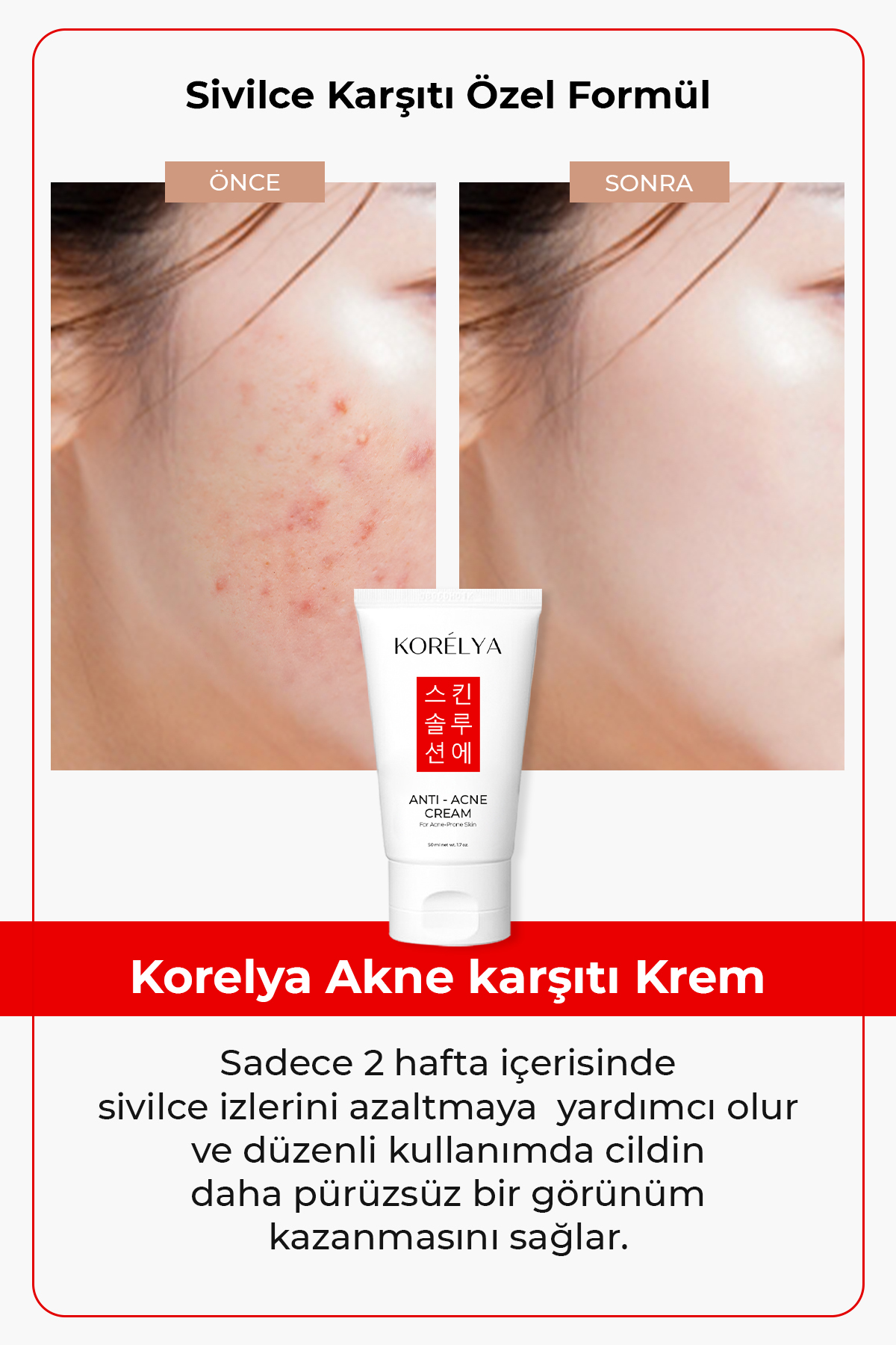 KORELYA Sivilce Kremi 50 ml - Görsel 2