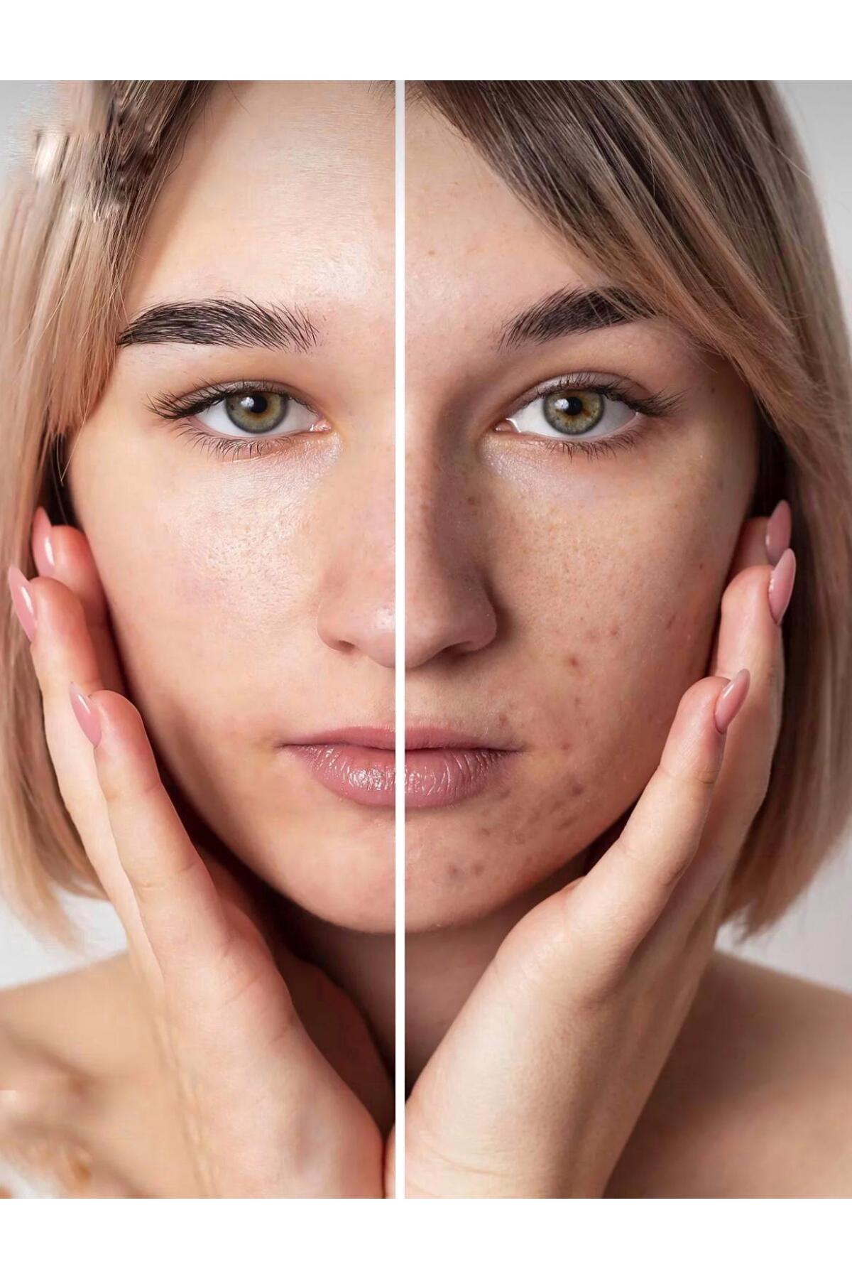 My pearl Sivilcee1 Karşıtı Akne Önleyici Yenileyici Bakım Kremi 100ml - Görsel 2