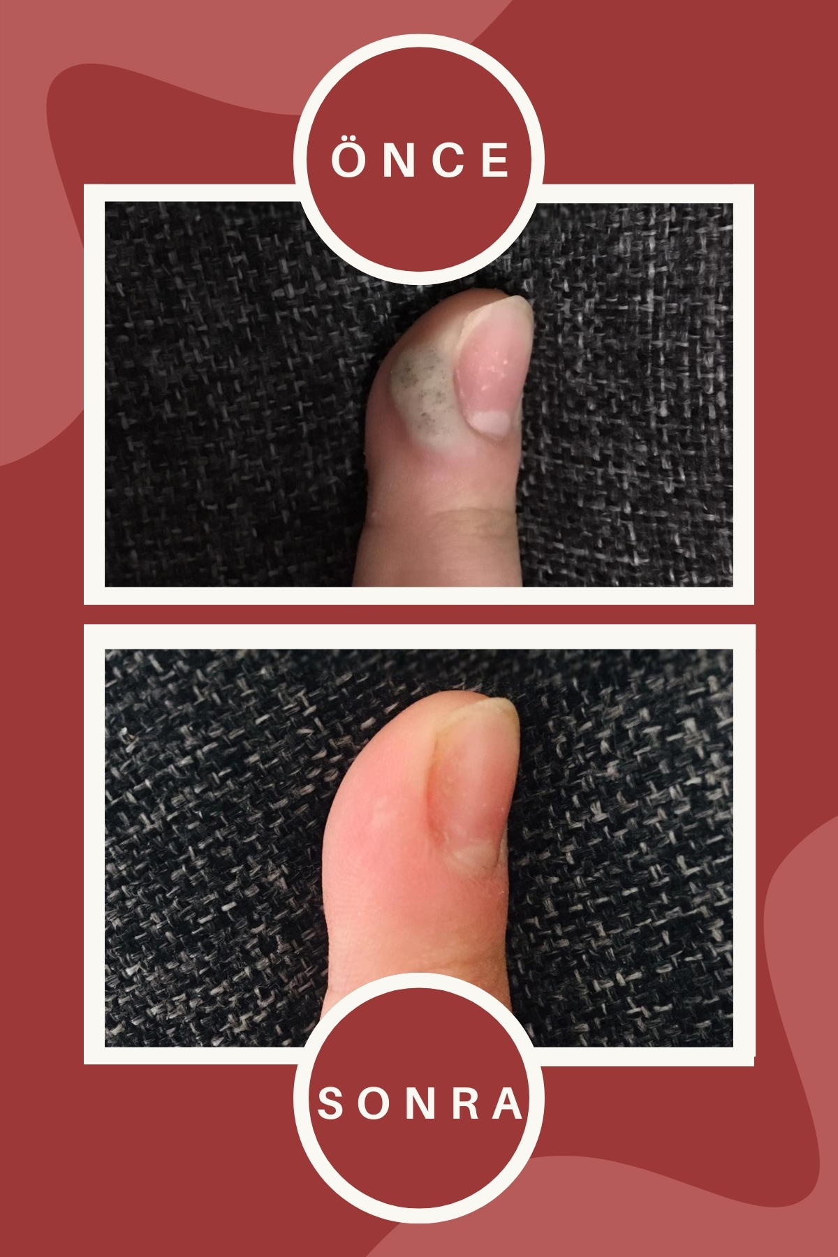 Siğilex Siğil Giderici Solüsyon, Siğil Sökücü - Görsel 2