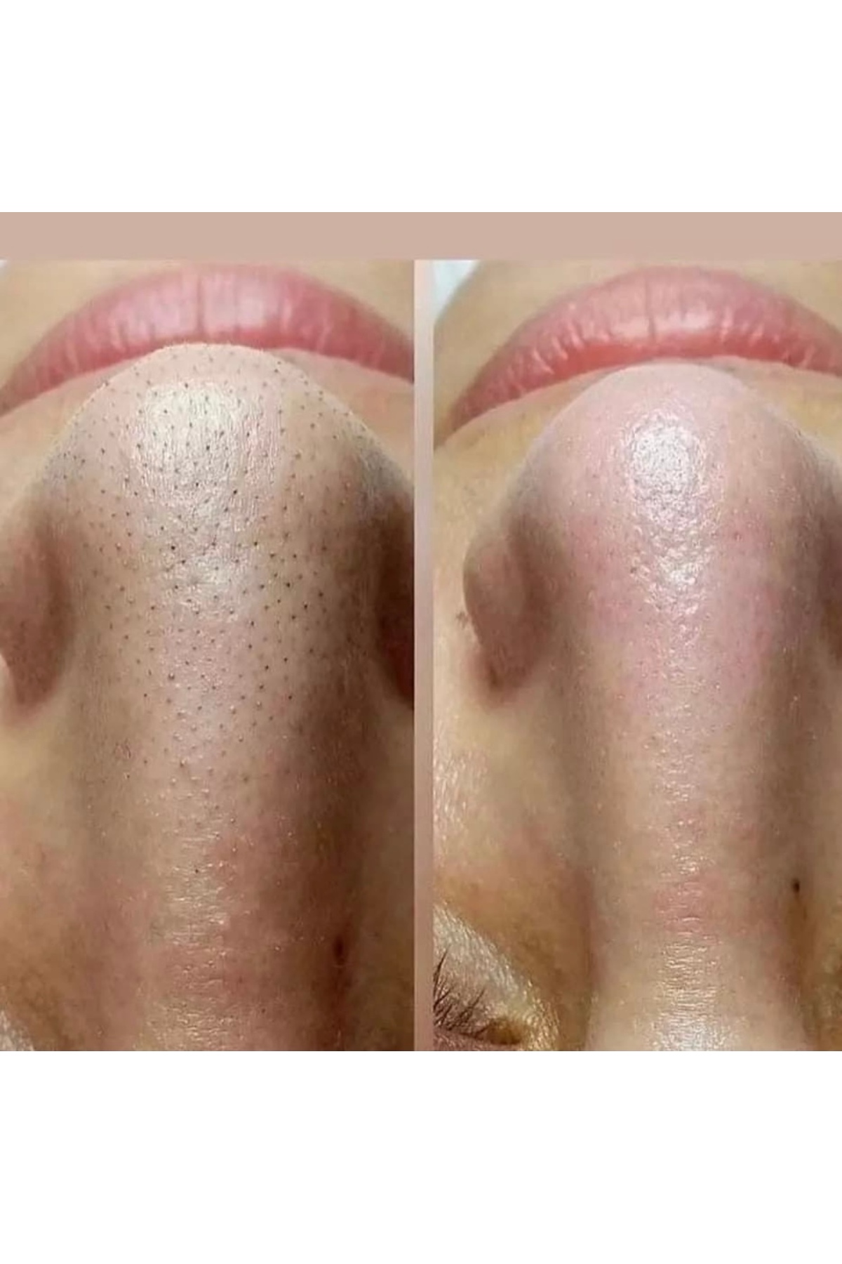 Egş DERMA delete DERMADELETE PEELİNG JEL(SOYUCU KREM) + Egş f120 GÜNEŞ KREMİ - Görsel 2