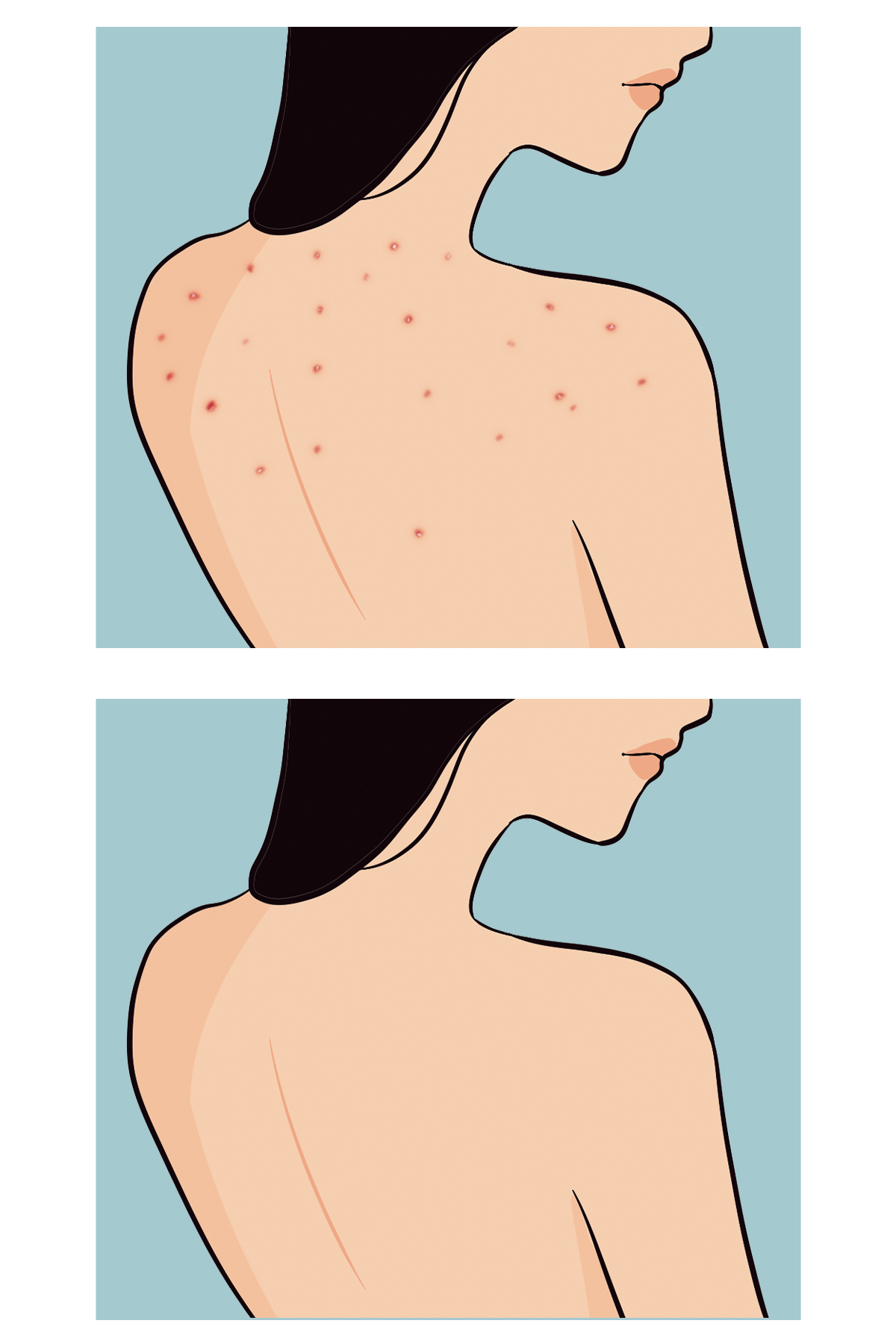 Skin Sensual Buttoks Buttne Vücut Maskesi | Vücut Sivilceleri ve Pürüzlere Karşı | 2 Parça - Görsel 3